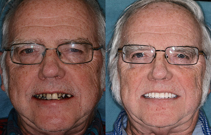Advanced Custom Full Denture Set