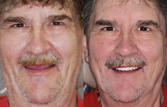 Advanced Custom Full Denture Set