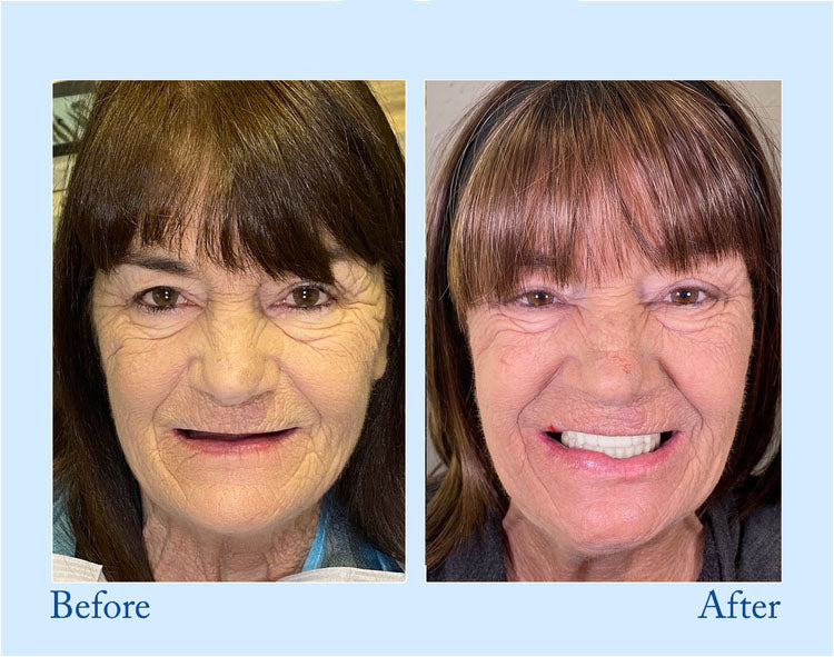 Premium Denture