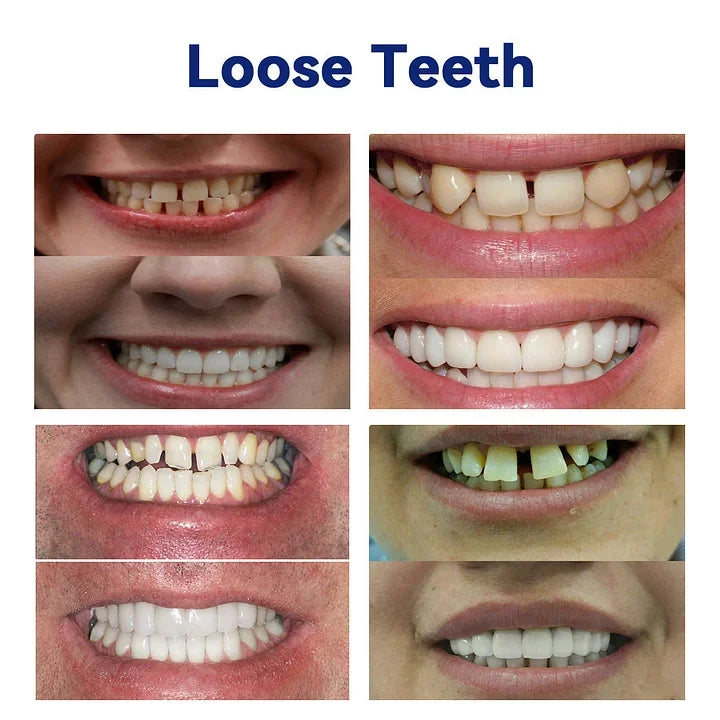 Flexible Full Denture