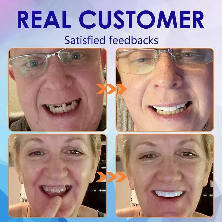 Flexible Full Denture