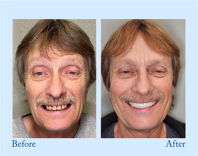 Premium Denture
