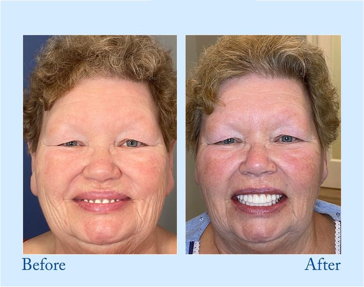 Premium Denture