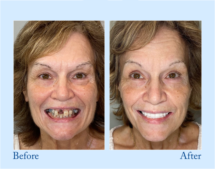 Smileasego™ - Premium Denture