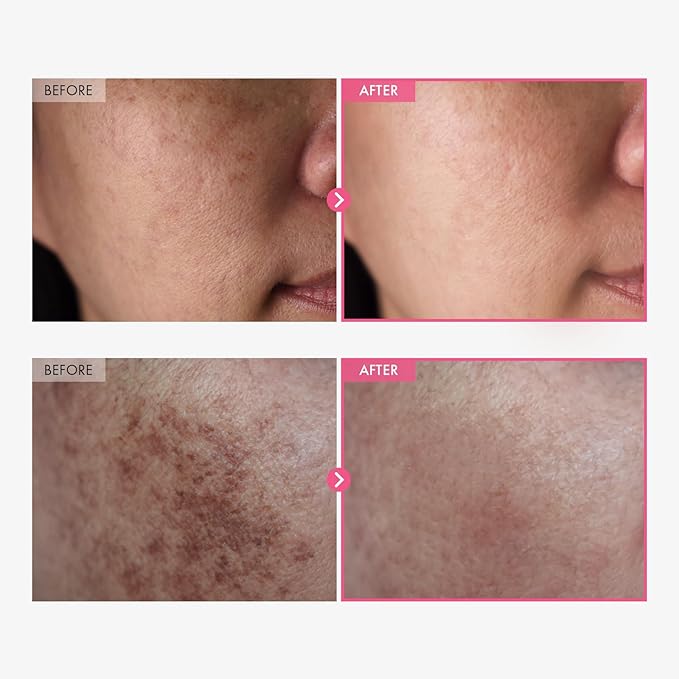 Arbutin 7% & Tranexamic Acid 4% Cream with Niacinamide for Dark Spots & Pigmentation