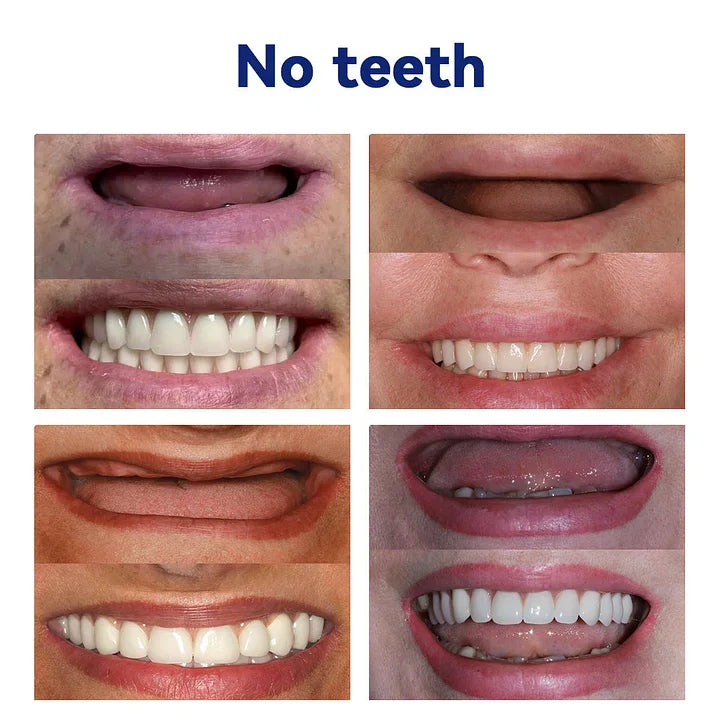 Flexible Full Denture