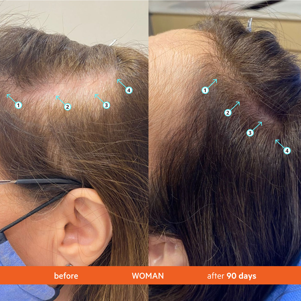 Hair Density Thickening Shampoo with Biotin and Caffeine for Fuller Hair