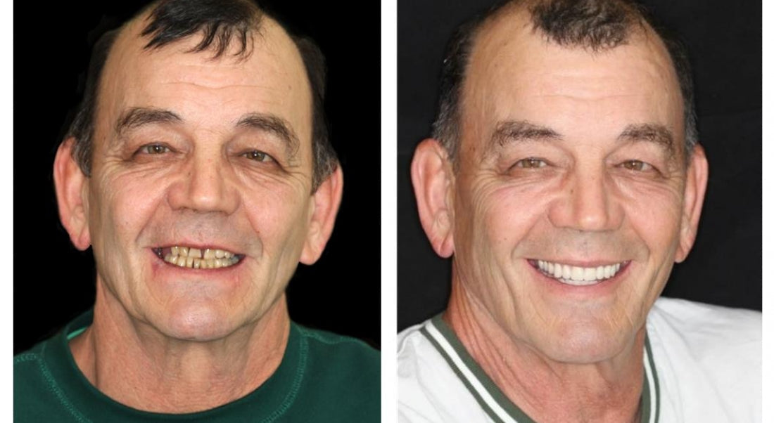 Advanced Custom Full Denture Set
