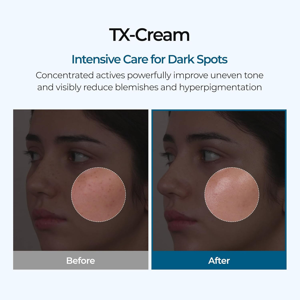 TX Tranexamic Acid Cream for Dark Spots, Freckles and Blemishes