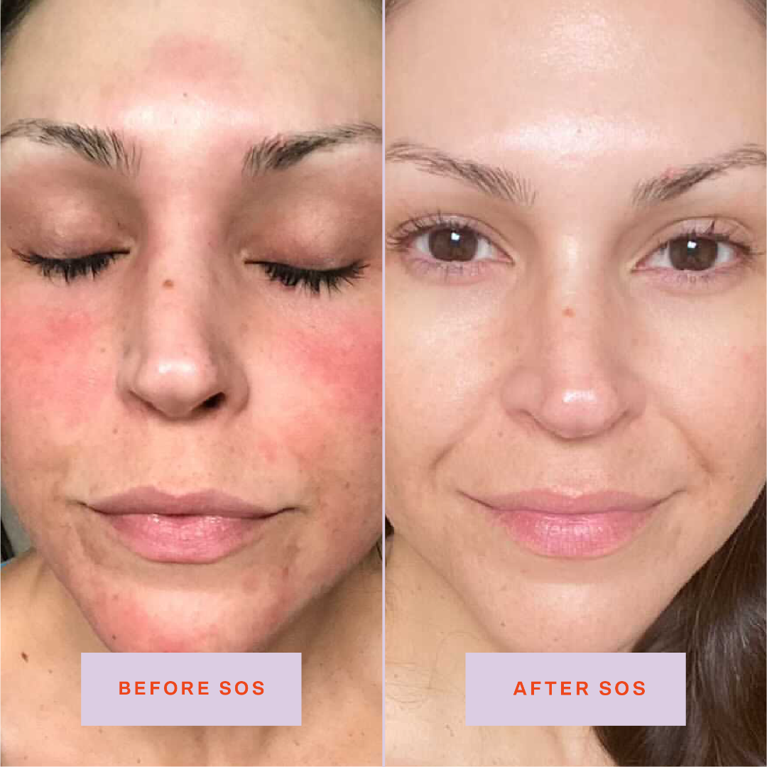 SOS Rescue Spray Hypochlorous Acid Facial Spray for Breakouts