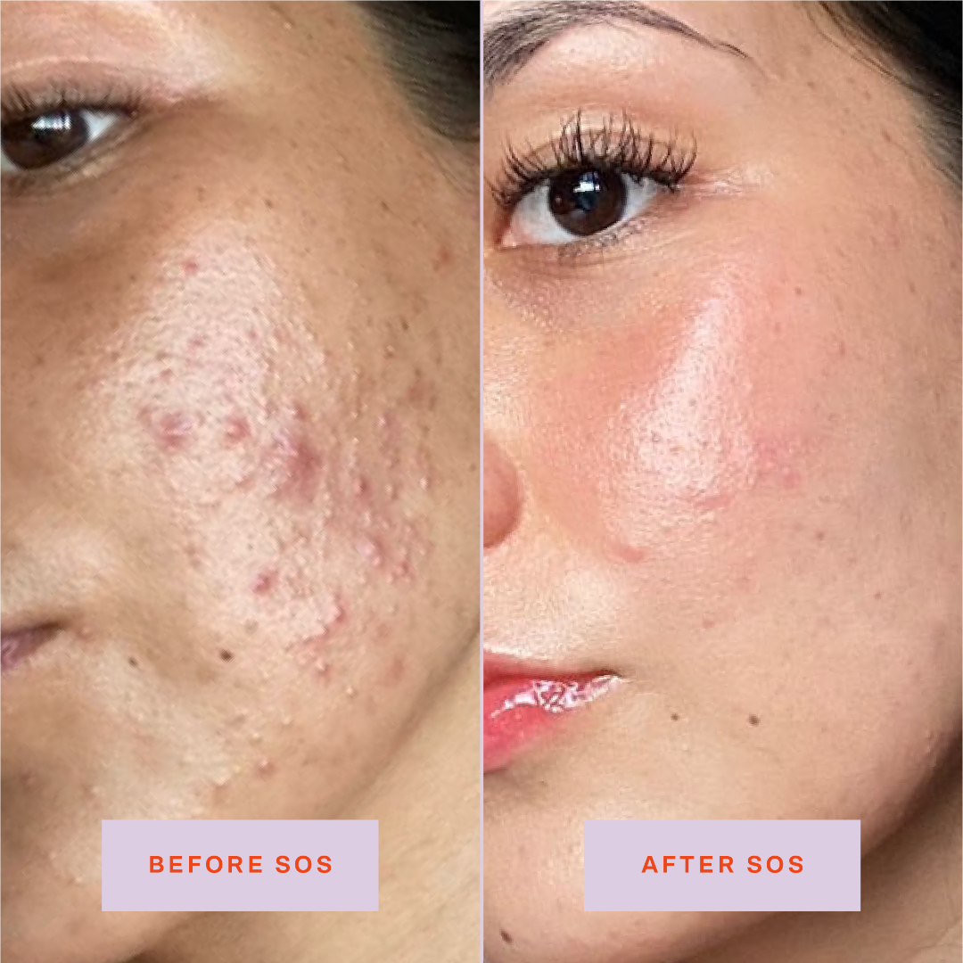 SOS Rescue Spray Hypochlorous Acid Facial Spray for Breakouts