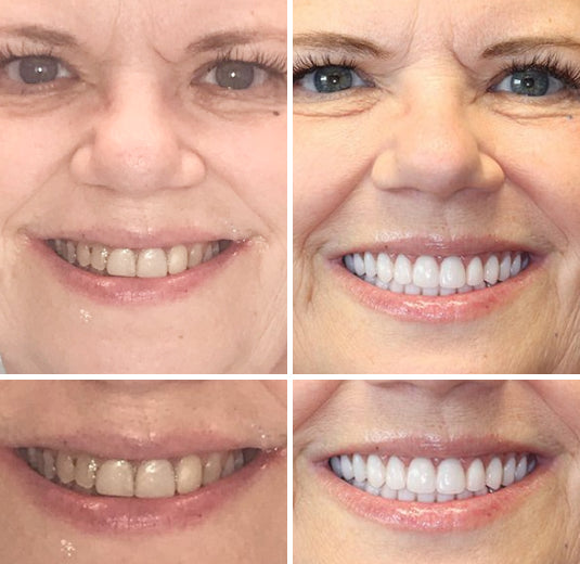 Advanced Custom Full Denture Set