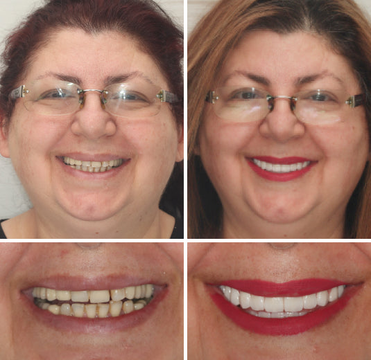 Advanced Custom Full Denture Set