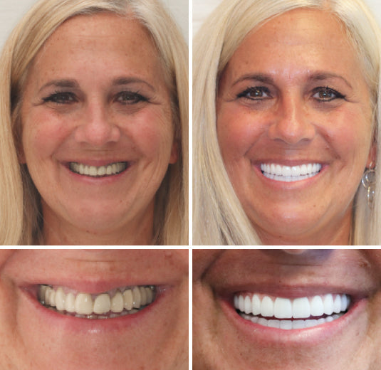 Advanced Custom Full Denture Set