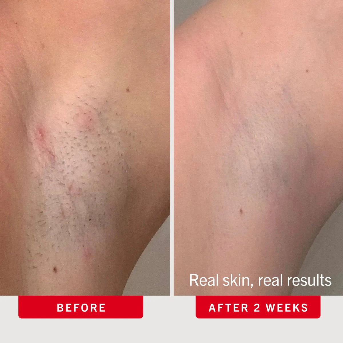 Bump-Smoothing Duo Ingrown Hair Pads & KP Scrub with Glycolic Acid