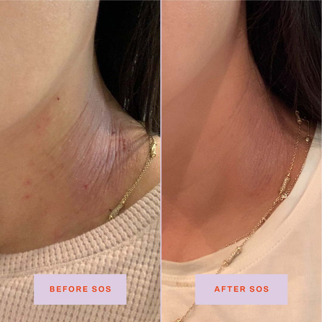 SOS Rescue Spray Hypochlorous Acid Facial Spray for Breakouts